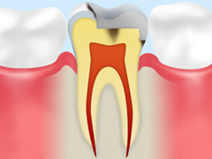 虫歯再発のリスクは治療法でも変わる