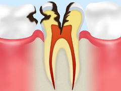 C3：神経に達した虫歯