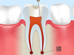 抜歯をしない虫歯治療